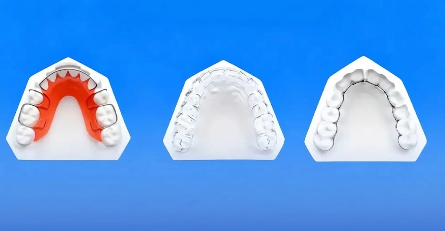 Retainer Types Inblog